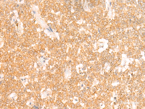 Immunohistochemistry of paraffin-embedded Human ovarian cancer tissue  using RRP8 Polyclonal Antibody at dilution of 1:50(×200)