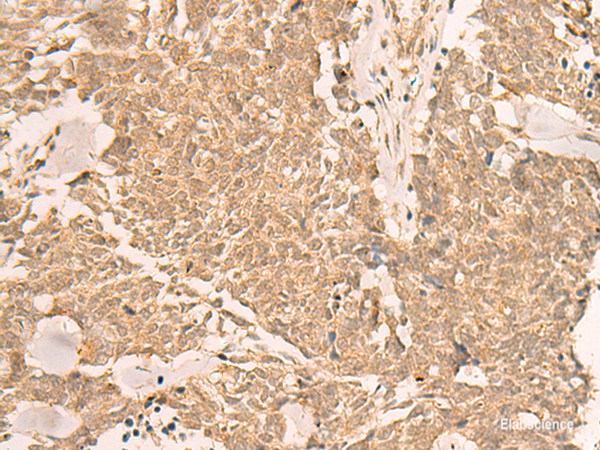 Immunohistochemistry of paraffin-embedded Human lung cancer tissue  using IL1RAPL2 Polyclonal Antibody at dilution of 1:25(×200)