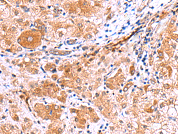 Immunohistochemistry of paraffin-embedded Human liver cancer tissue  using IRGC Polyclonal Antibody at dilution of 1:30(×200)