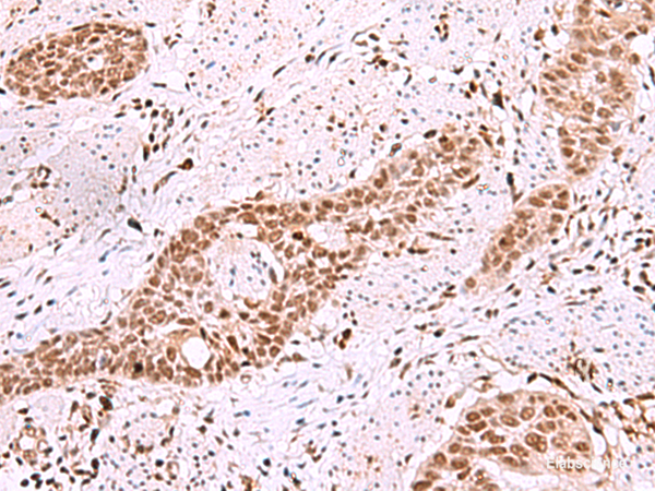 Immunohistochemistry of paraffin-embedded Human esophagus cancer tissue  using ISL2 Polyclonal Antibody at dilution of 1:40(×200)