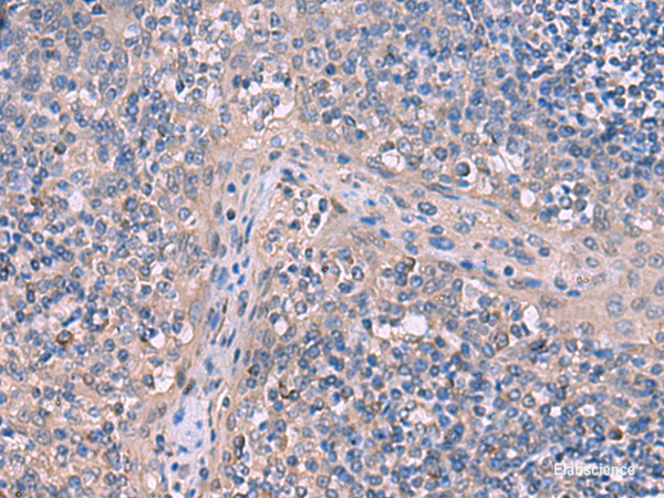Immunohistochemistry of paraffin-embedded Human tonsil tissue  using ITPR2 Polyclonal Antibody at dilution of 1:65(×200)
