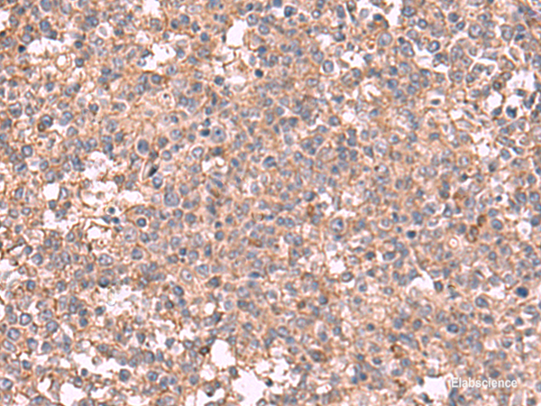 Immunohistochemistry of paraffin-embedded Human tonsil tissue  using MAPK8IP3 Polyclonal Antibody at dilution of 1:45(×200)