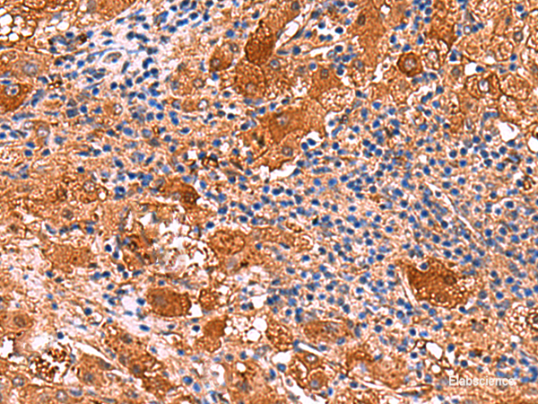 Immunohistochemistry of paraffin-embedded Human liver cancer tissue  using KANK3 Polyclonal Antibody at dilution of 1:50(×200)