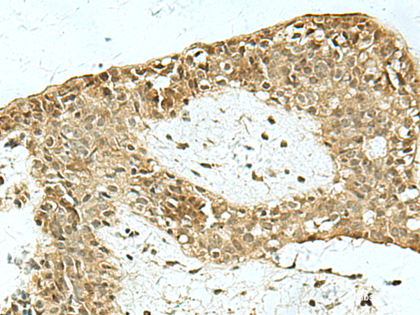 Immunohistochemistry of paraffin-embedded Human breast cancer tissue  using KAT7 Polyclonal Antibody at dilution of 1:55(×200)
