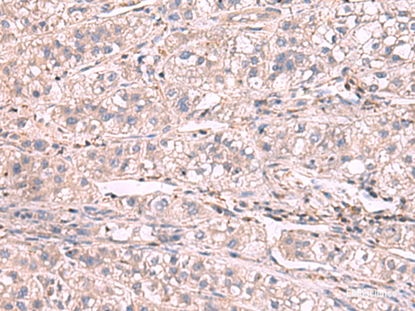 Immunohistochemistry of paraffin-embedded Human liver cancer tissue  using KCNIP1 Polyclonal Antibody at dilution of 1:60(×200)