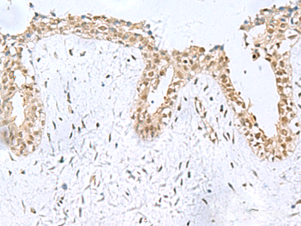 Immunohistochemistry of paraffin-embedded Human breast cancer tissue  using KDM2B Polyclonal Antibody at dilution of 1:50(×200)