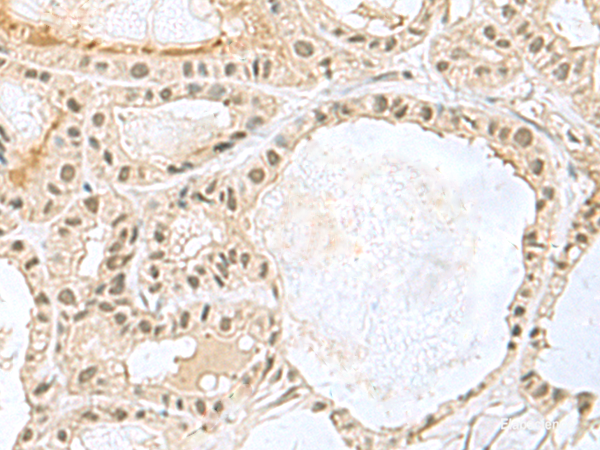 Immunohistochemistry of paraffin-embedded Human thyroid cancer tissue  using KDM3B Polyclonal Antibody at dilution of 1:45(×200)