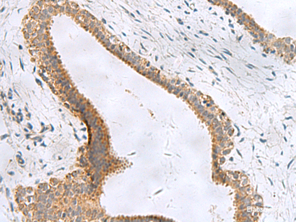 Immunohistochemistry of paraffin-embedded Human breast cancer tissue  using CEMIP Polyclonal Antibody at dilution of 1:120(×200)