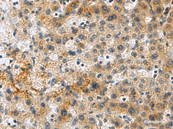 Immunohistochemistry of paraffin-embedded Human liver cancer tissue  using PLIN4 Polyclonal Antibody at dilution of 1:50(×200)