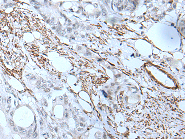 Immunohistochemistry of paraffin-embedded Human colorectal cancer tissue  using GJA5 Polyclonal Antibody at dilution of 1:50(×200)