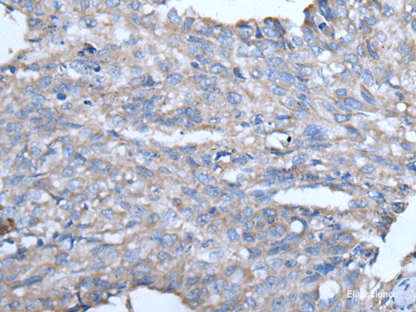 Immunohistochemistry of paraffin-embedded Human lung cancer tissue  using GJA1 Polyclonal Antibody at dilution of 1:50(×200)
