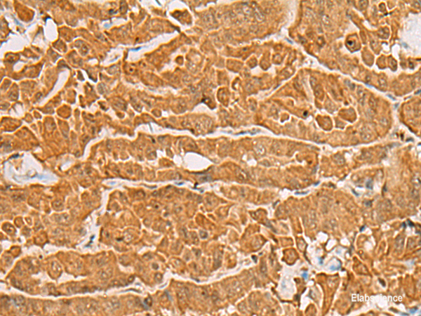 Immunohistochemistry of paraffin-embedded Human thyroid cancer tissue  using MAPK14 Polyclonal Antibody at dilution of 1:60(×200)