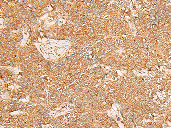 Immunohistochemistry of paraffin-embedded Human ovarian cancer tissue  using PDCD4 Polyclonal Antibody at dilution of 1:35(×200)