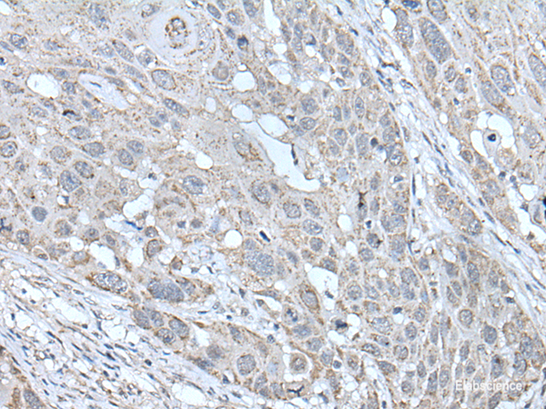 Immunohistochemistry of paraffin-embedded Human esophagus cancer tissue  using SCNN1G Polyclonal Antibody at dilution of 1:40(×200)