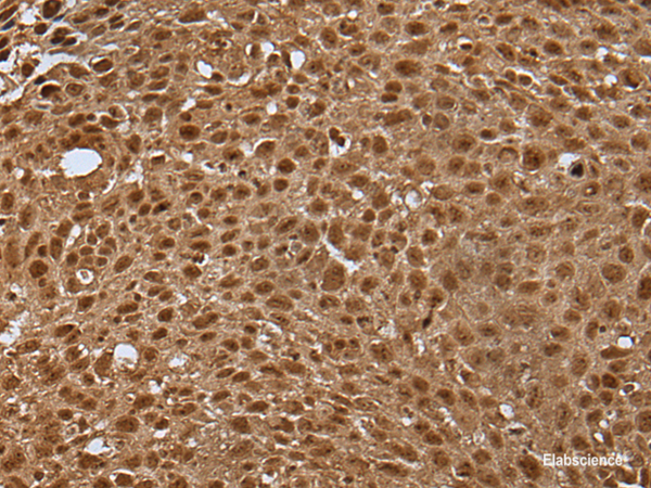 Immunohistochemistry of paraffin-embedded Human lung cancer tissue  using LAMTOR5 Polyclonal Antibody at dilution of 1:35(×200)