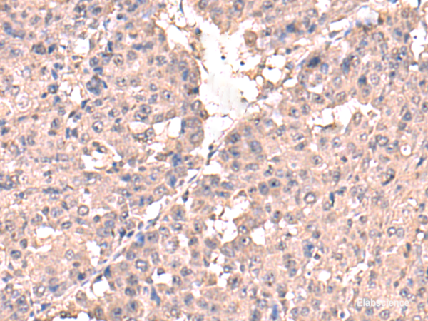 Immunohistochemistry of paraffin-embedded Human liver cancer tissue  using HPN Polyclonal Antibody at dilution of 1:50(×200)