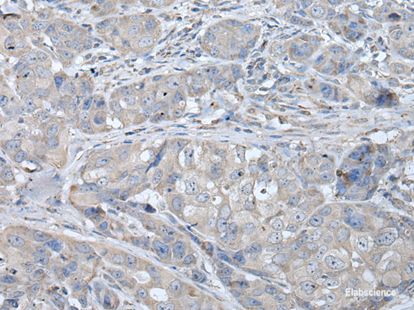 Immunohistochemistry of paraffin-embedded Human breast cancer tissue  using RASA1 Polyclonal Antibody at dilution of 1:40(×200)