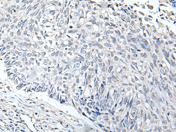 Immunohistochemistry of paraffin-embedded Human lung cancer tissue  using RERG Polyclonal Antibody at dilution of 1:65(×200)