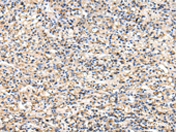 Immunohistochemistry of paraffin-embedded Human prost at e cancer tissue  using VCAM1 Polyclonal Antibody at dilution of 1:30(×200)
