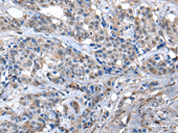 Immunohistochemistry of paraffin-embedded Human breast cancer tissue  using ZFP2 Polyclonal Antibody at dilution of 1:40(×200)