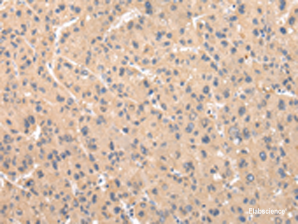 Immunohistochemistry of paraffin-embedded Human liver cancer tissue  using ZNF268 Polyclonal Antibody at dilution of 1:50(×200)