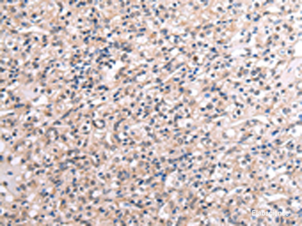 Immunohistochemistry of paraffin-embedded Human liver cancer tissue  using RNF115 Polyclonal Antibody at dilution of 1:45(×200)