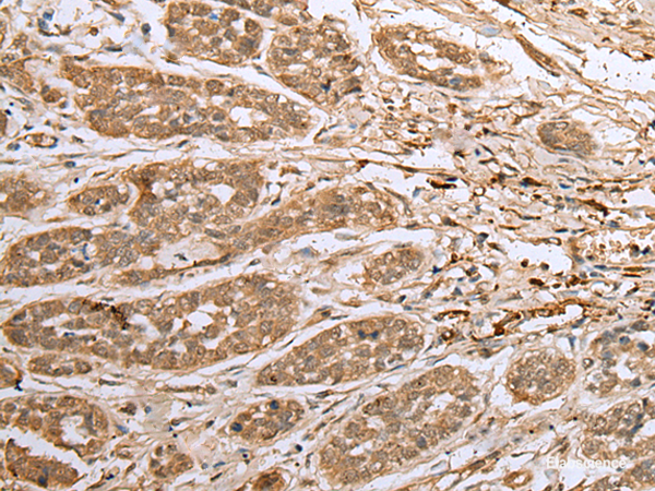 Immunohistochemistry of paraffin-embedded Human esophagus cancer tissue  using ATXN7L3 Polyclonal Antibody at dilution of 1:40(×200)