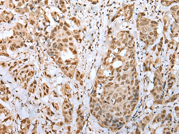 Immunohistochemistry of paraffin-embedded Human breast cancer tissue  using ZNF486 Polyclonal Antibody at dilution of 1:50(×200)