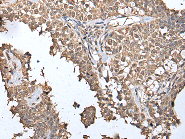 Immunohistochemistry of paraffin-embedded Human ovarian cancer tissue  using METAP1D Polyclonal Antibody at dilution of 1:40(×200)