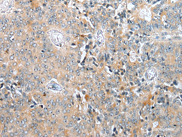 Immunohistochemistry of paraffin-embedded Human prost at e cancer tissue  using COMMD6 Polyclonal Antibody at dilution of 1:45(×200)