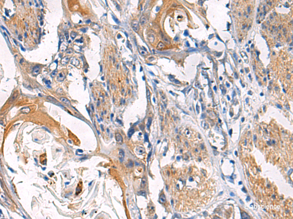 Immunohistochemistry of paraffin-embedded Human esophagus cancer tissue  using LYPLA1 Polyclonal Antibody at dilution of 1:45(×200)