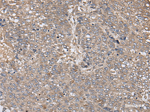 Immunohistochemistry of paraffin-embedded Human liver cancer tissue  using ZFP36 Polyclonal Antibody at dilution of 1:40(×200)