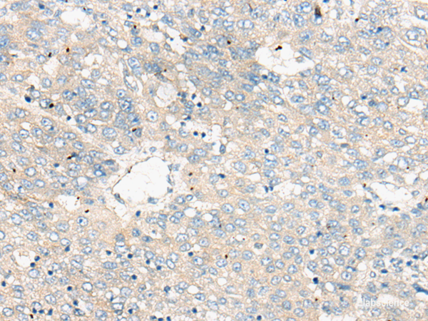 Immunohistochemistry of paraffin-embedded Human liver cancer tissue  using ZNF449 Polyclonal Antibody at dilution of 1:50(×200)