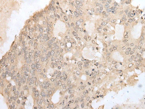 Immunohistochemistry of paraffin-embedded Human colorectal cancer tissue  using ZZZ3 Polyclonal Antibody at dilution of 1:50(×200)