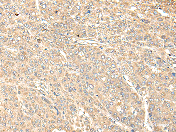 Immunohistochemistry of paraffin-embedded Human liver cancer tissue  using WDFY4 Polyclonal Antibody at dilution of 1:50(×200)