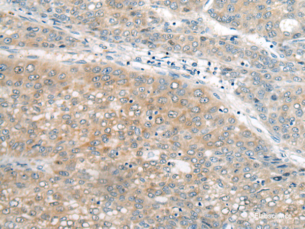 Immunohistochemistry of paraffin-embedded Human liver cancer tissue  using UBE2G2 Polyclonal Antibody at dilution of 1:55(×200)