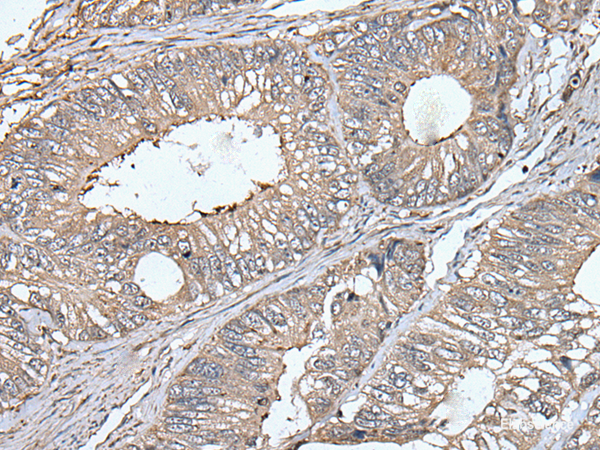 Immunohistochemistry of paraffin-embedded Human colorectal cancer tissue  using UNC13B Polyclonal Antibody at dilution of 1:40(×200)