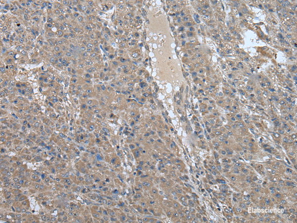 Immunohistochemistry of paraffin-embedded Human liver cancer tissue  using USP32 Polyclonal Antibody at dilution of 1:75(×200)