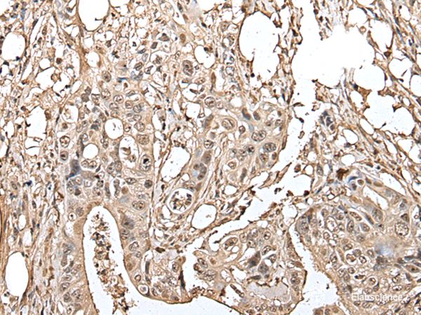 Immunohistochemistry of paraffin-embedded Human colorectal cancer tissue  using UTP3 Polyclonal Antibody at dilution of 1:40(×200)