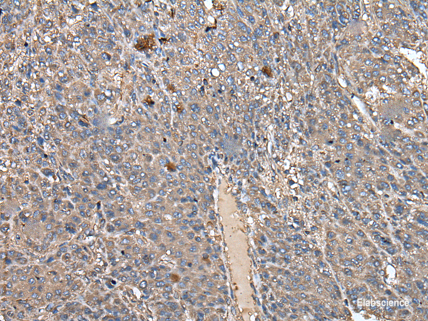 Immunohistochemistry of paraffin-embedded Human liver cancer tissue  using ATAD1 Polyclonal Antibody at dilution of 1:50(×200)