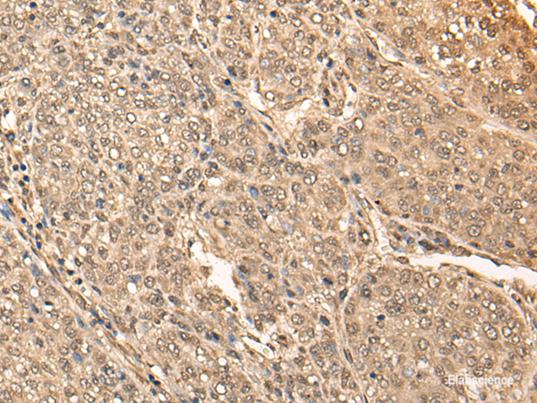 Immunohistochemistry of paraffin-embedded Human liver cancer tissue  using BRF2 Polyclonal Antibody at dilution of 1:40(×200)
