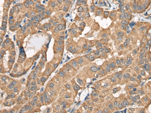 Immunohistochemistry of paraffin-embedded Human thyroid cancer tissue  using BCHE Polyclonal Antibody at dilution of 1:40(×200)