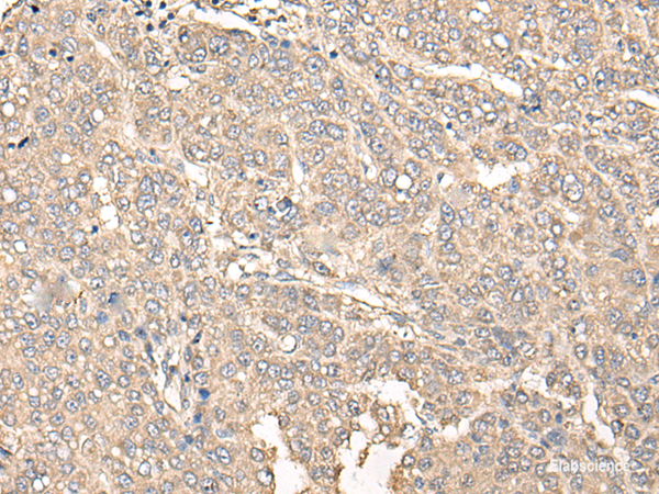 Immunohistochemistry of paraffin-embedded Human liver cancer tissue  using C12orf40 Polyclonal Antibody at dilution of 1:50(×200)