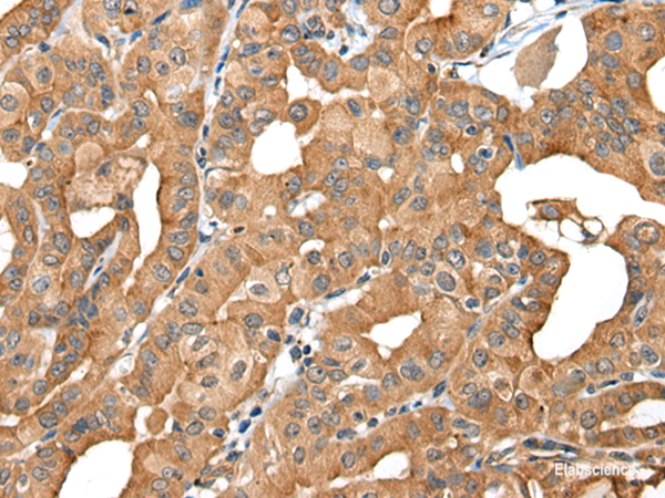 Immunohistochemistry of paraffin-embedded Human thyroid cancer tissue  using INF2 Polyclonal Antibody at dilution of 1:40(×200)