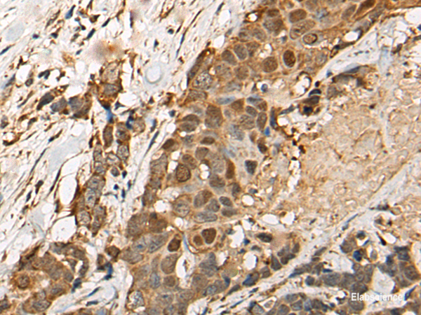 Immunohistochemistry of paraffin-embedded Human thyroid cancer tissue  using HEATR9 Polyclonal Antibody at dilution of 1:110(×200)