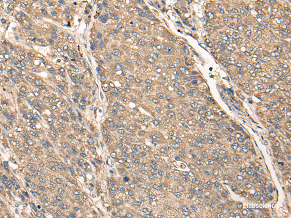 Immunohistochemistry of paraffin-embedded Human liver cancer tissue  using C17orf67 Polyclonal Antibody at dilution of 1:50(×200)