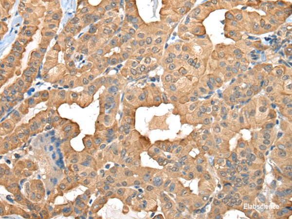 Immunohistochemistry of paraffin-embedded Human thyroid cancer tissue  using C1GALT1C1 Polyclonal Antibody at dilution of 1:45(×200)