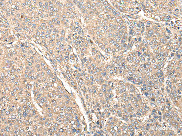 Immunohistochemistry of paraffin-embedded Human liver cancer tissue  using C1orf106 Polyclonal Antibody at dilution of 1:80(×200)