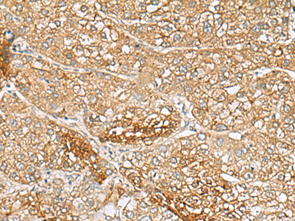 Immunohistochemistry of paraffin-embedded Human liver cancer tissue  using C1orf112 Polyclonal Antibody at dilution of 1:110(×200)