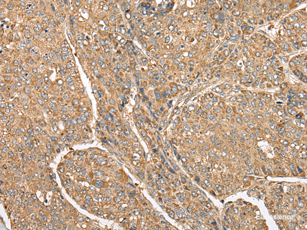 Immunohistochemistry of paraffin-embedded Human liver cancer tissue  using C5AR1 Polyclonal Antibody at dilution of 1:50(×200)